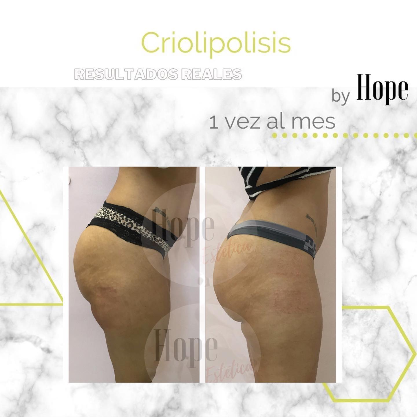 Antes y después de criolipolisis, de perfil: la misma clienta, con el mismo tatuaje en la zona lumbar