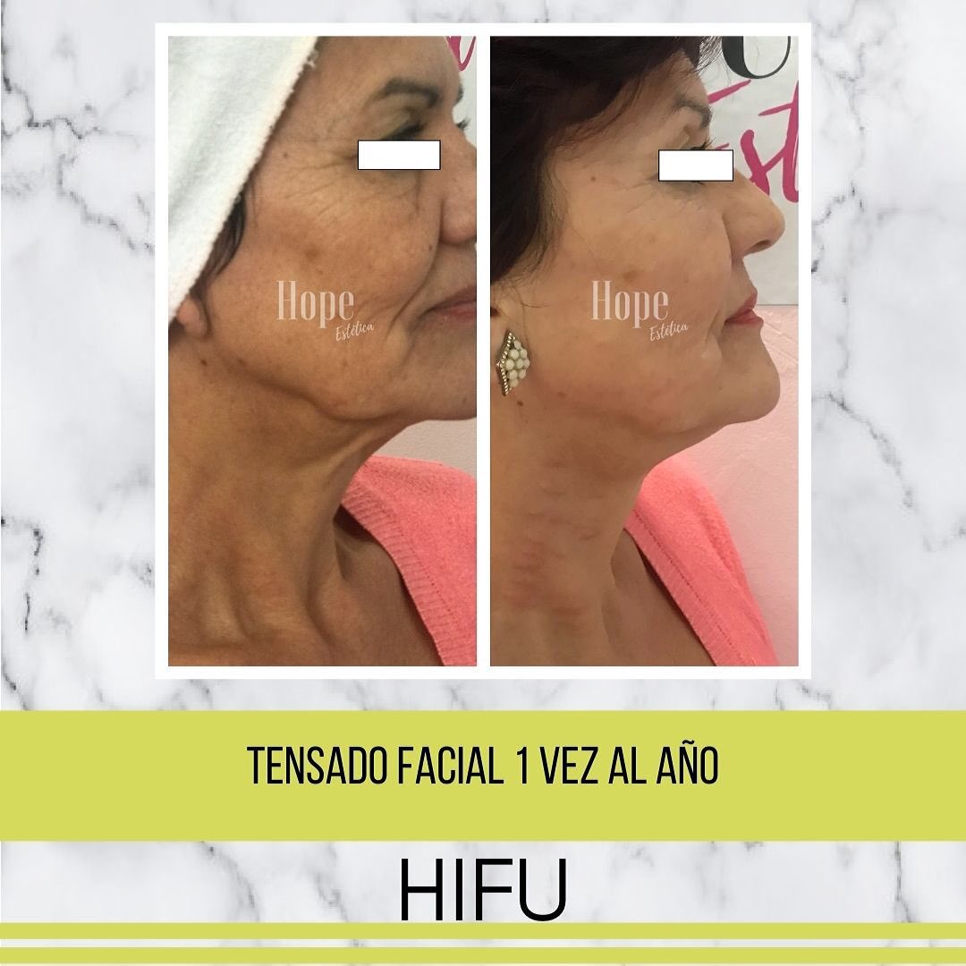 Antes y después de un tensado facial con HIFU: el mismo perfil de una clienta, con los ojos tapados como lo publicamos
